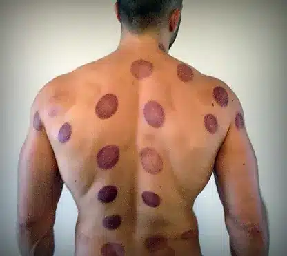 الأيام المكروهة للحجامة