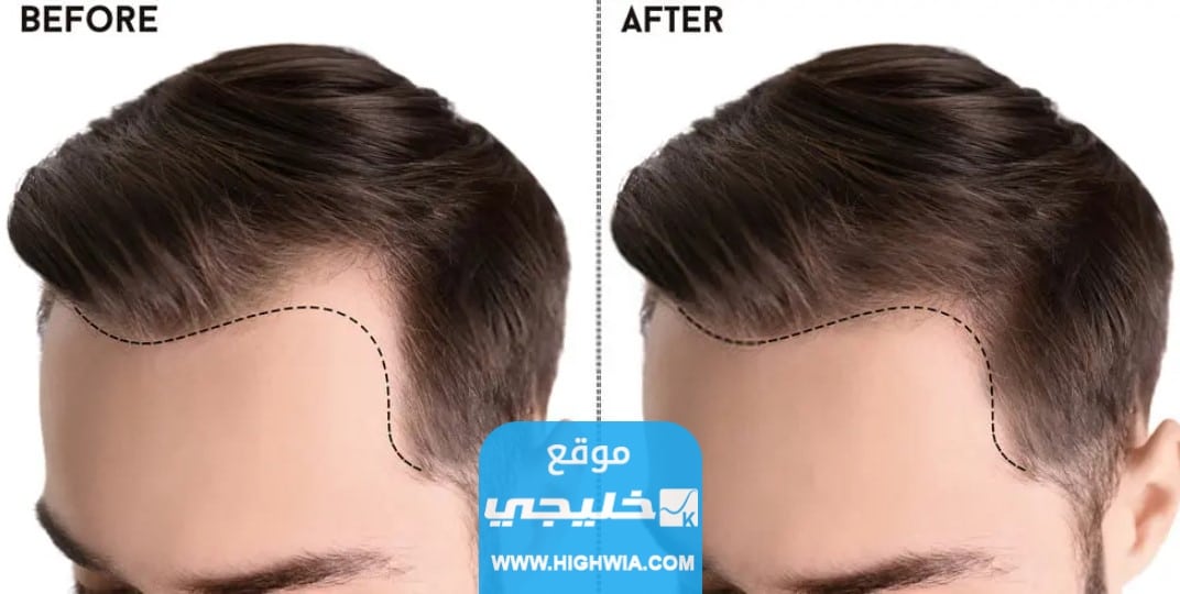 مركز ديرماكير للعناية بالشعر في الكويت