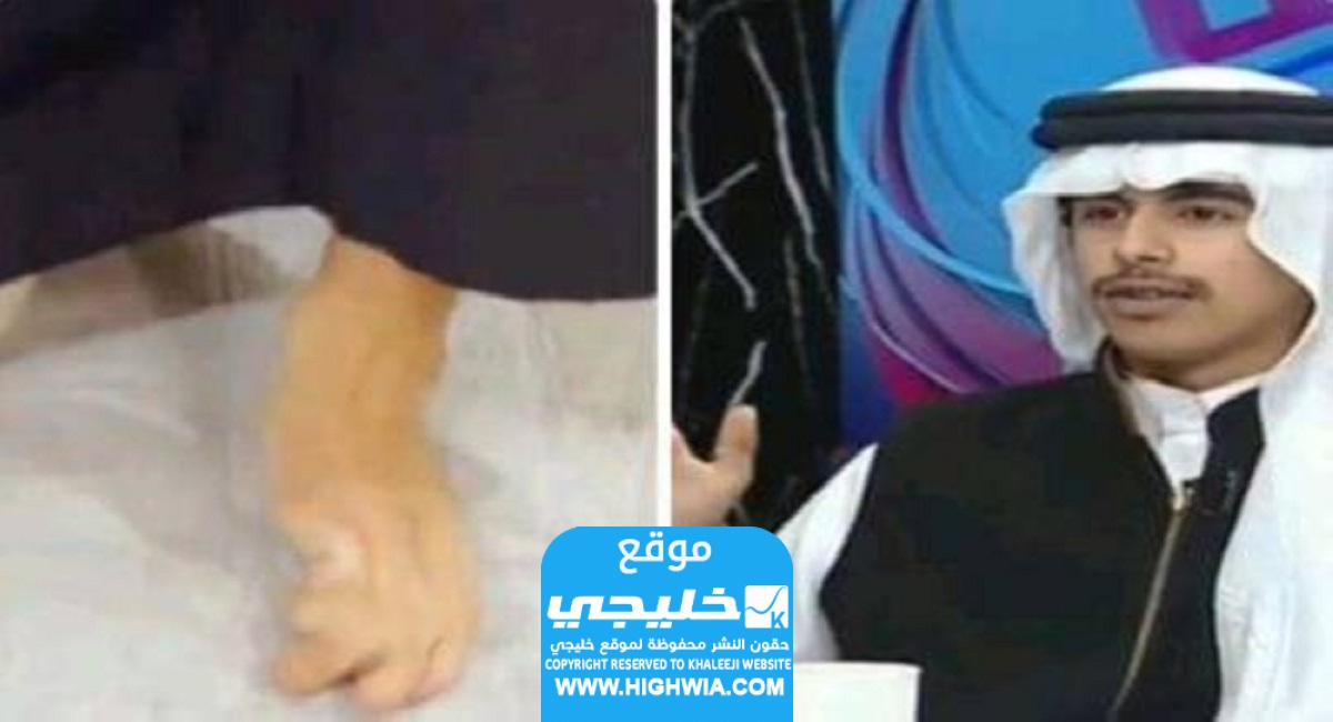 شبل قحطان يكشف سبب بتر قدمه